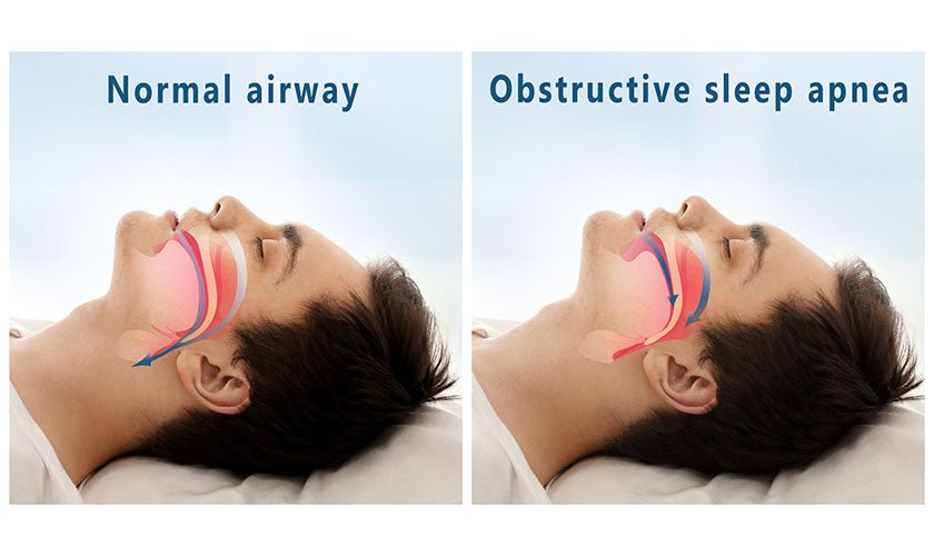 What is Obstructive sleep apnea?